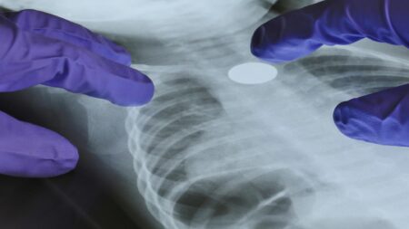 A Genetic Mutation May Help Explain Lung Cancer in Nonsmokers