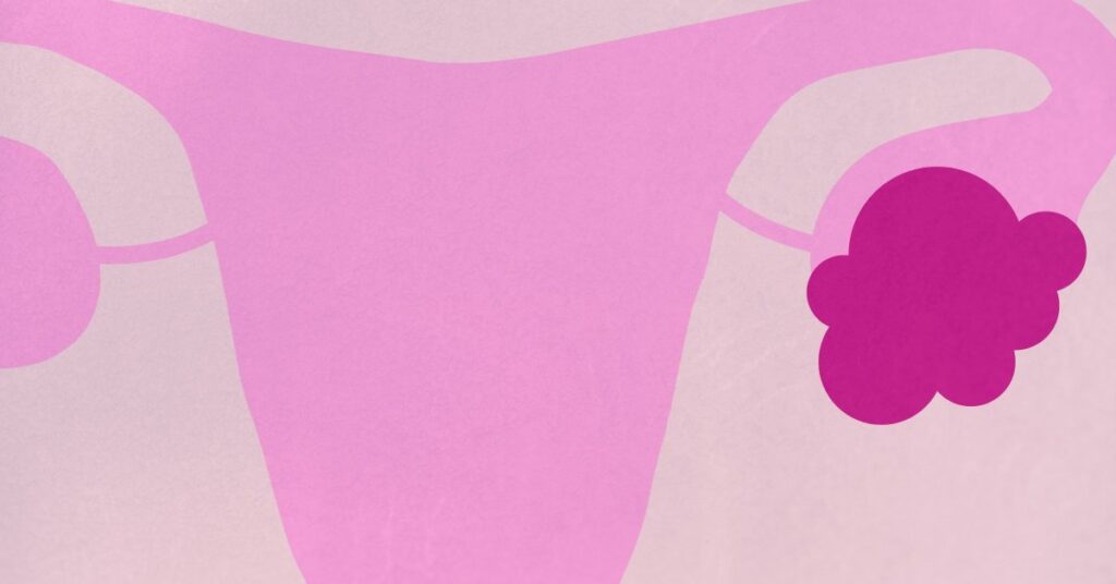 What to Do If You Get Diagnosed with an Ovarian Cyst