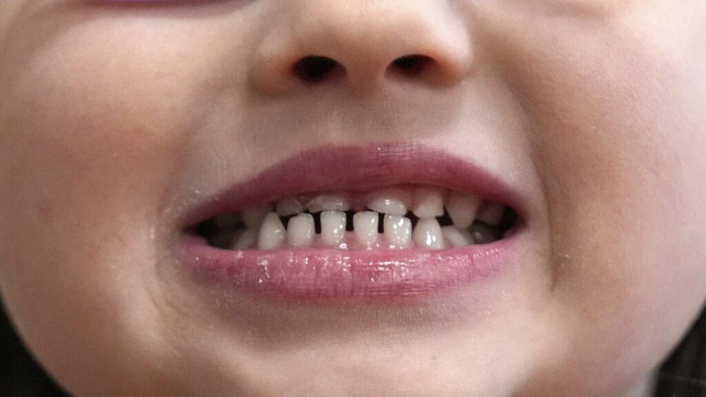 FDA and RFK Jr. aim to remove fluoride supplements used to protect kids’ teeth