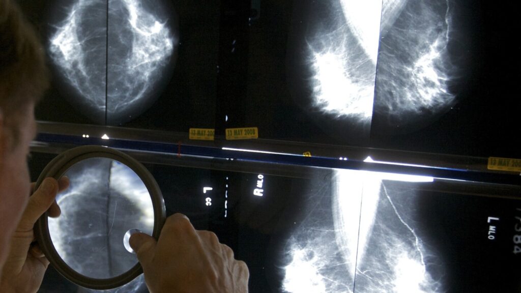 Cancer before age 50 is increasing. A new study looks at which types