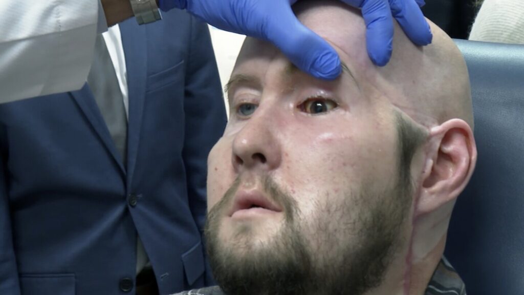 Man receives the world’s first eye transplant with a face transplant