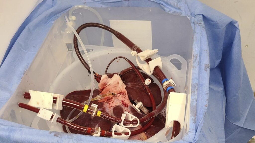 FDA OKs trial of pig livers as dialysis-like treatment for liver failure
