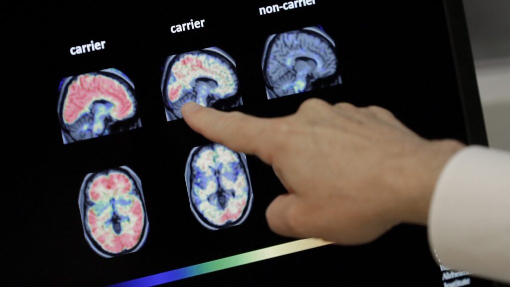 Shingles is awful, but here’s another reason to get vaccinated: It may fight dementia