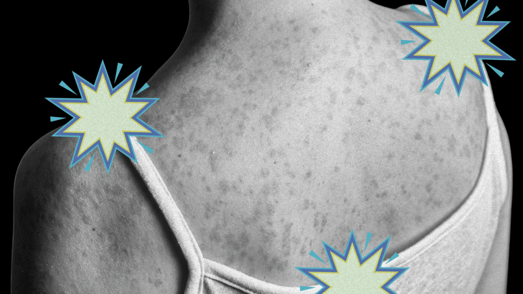The Long-Term Measles Complication Most People Don’t Know About The Long-Term Measles Complication Most People Don’t Know About